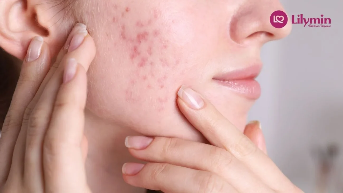 The Real Causes of Adult Acne and How to Stop It
